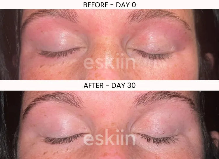 Close-up comparison of eye area before and after 30 days of skincare treatment.